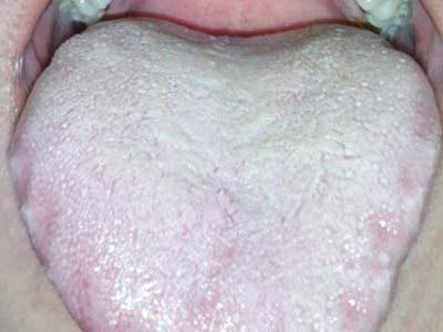 「健康养生」看看自己的舌头，是不是以下几种体质