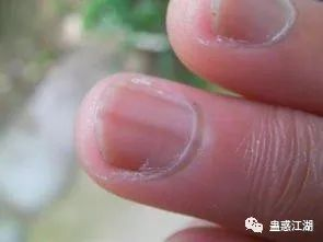 指甲有竖纹，是身体的什么信号？