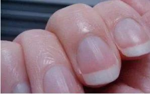 指甲有竖纹，是身体发出了什么信号？