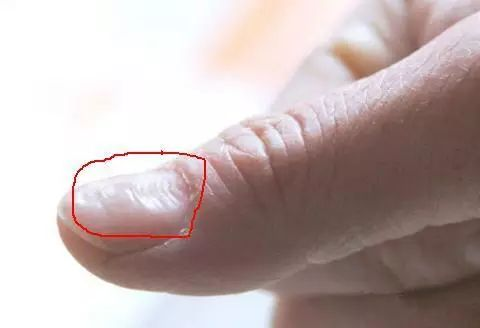 指甲有竖纹是身体什么信号？