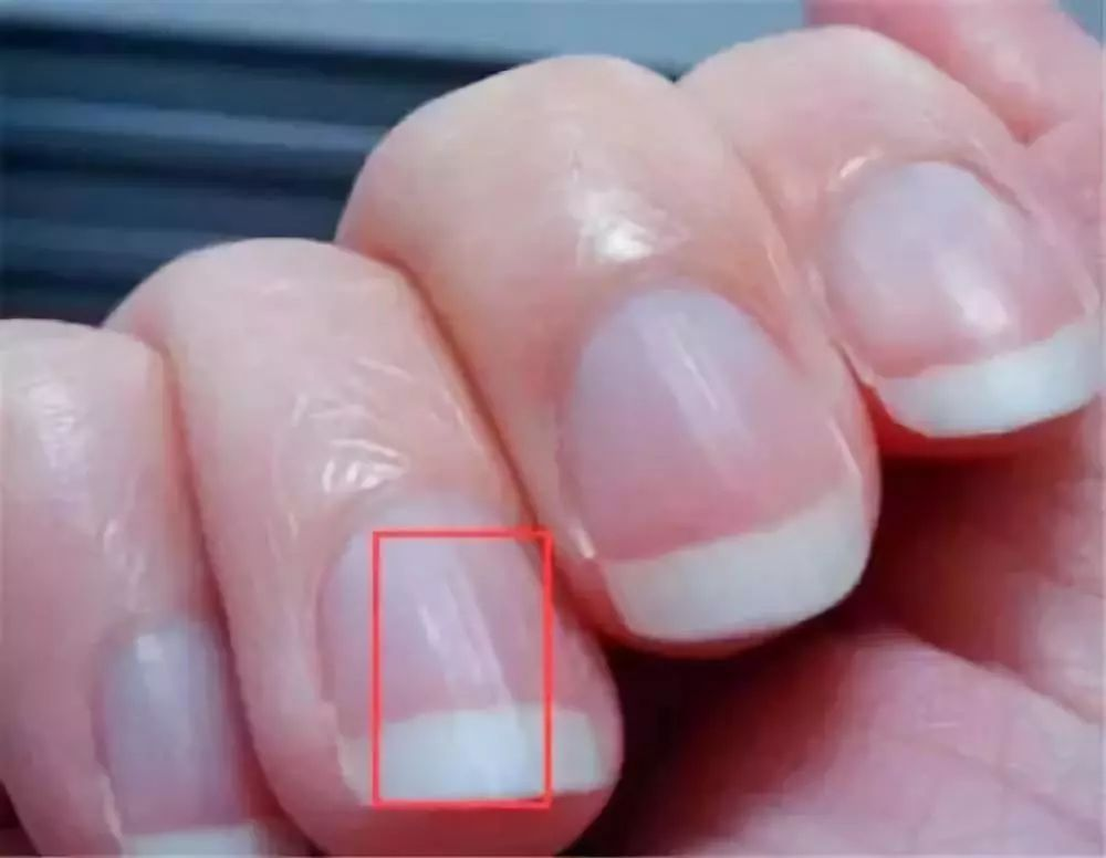 发现手指的指甲有竖纹，是身体的什么信号？