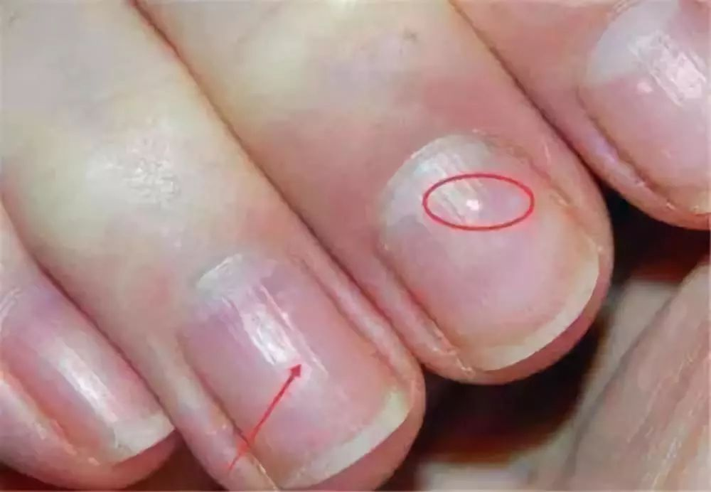 发现手指的指甲有竖纹，是身体的什么信号？