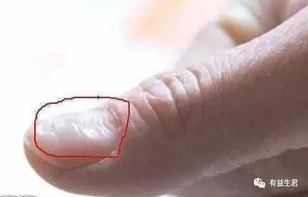指甲长了竖纹和横纹，是身体给的什么信号？