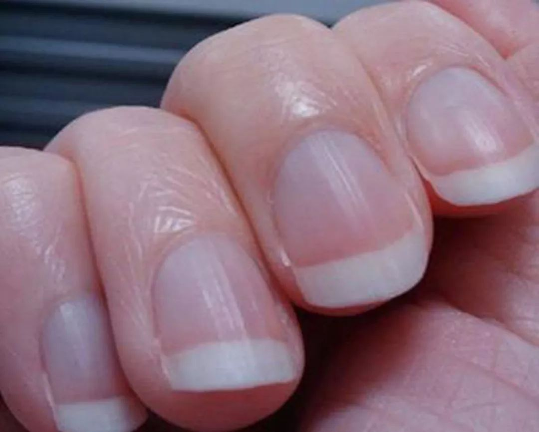 小心指甲上出现的竖纹，这可能是体内器官病变的求救信号！