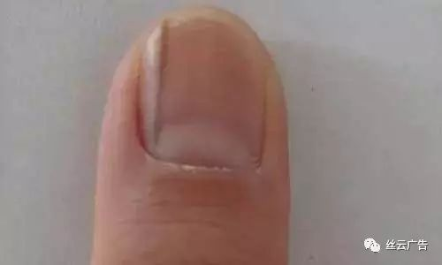 你了解指甲有横纹的身体信号吗, 指甲有竖纹是身体什么信号?