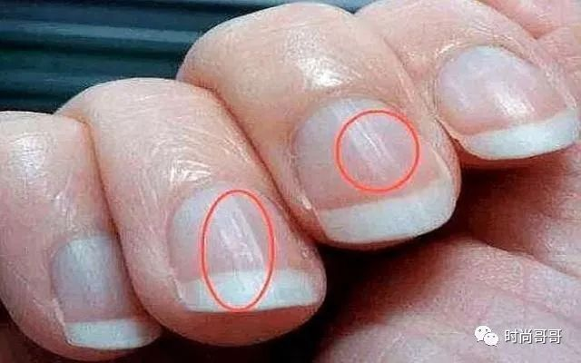 指甲上出现“竖纹”，是身体发出的信号？无论男女，不妨自测一下